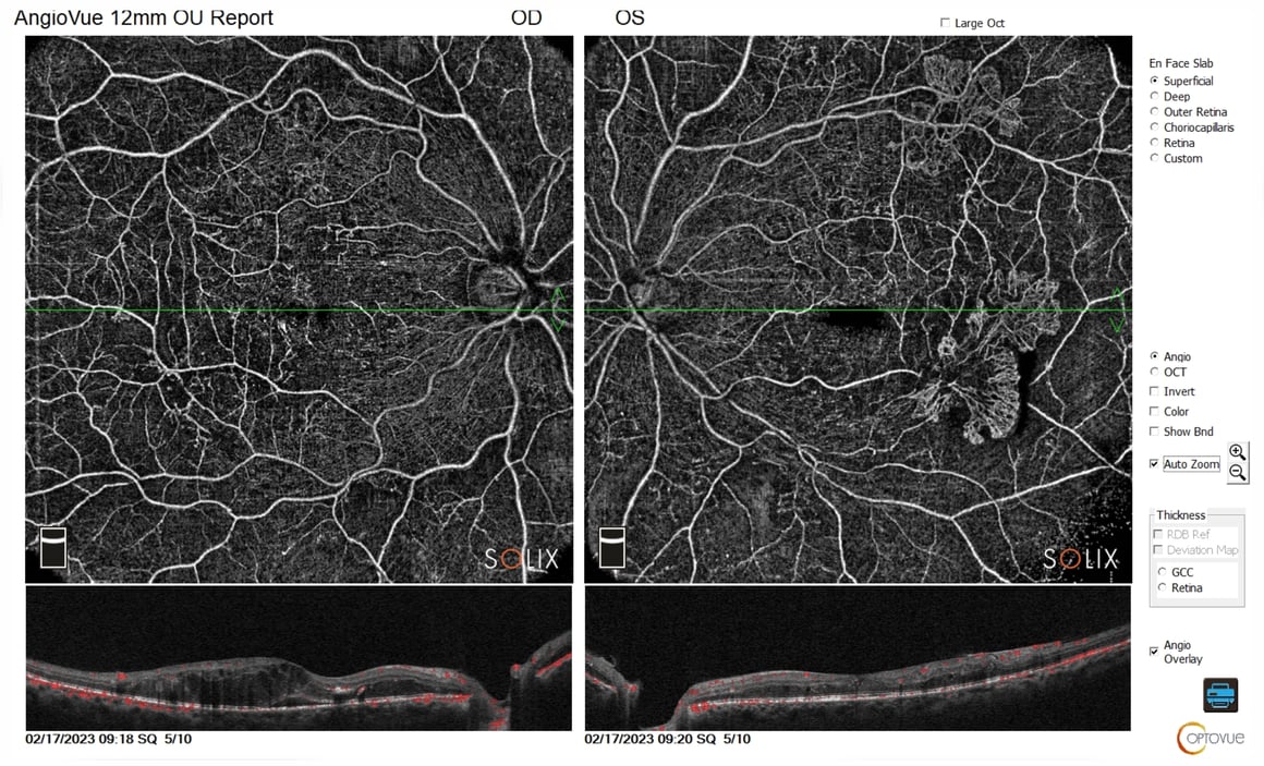 OCT-A of Proliferative Diabetic Retinopathy